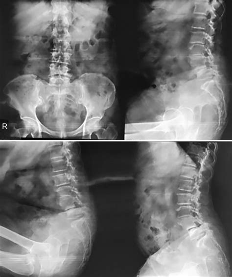 Clinical and Radiological Outcome of Transforaminal Lumbar Interbody ...
