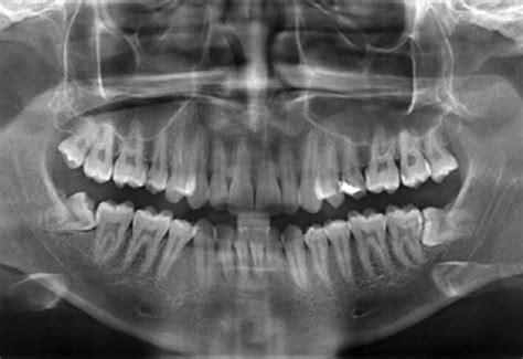 What is Dental X Ray OPG?| Purpoes | Types | Precuations | Cost in Pune ...