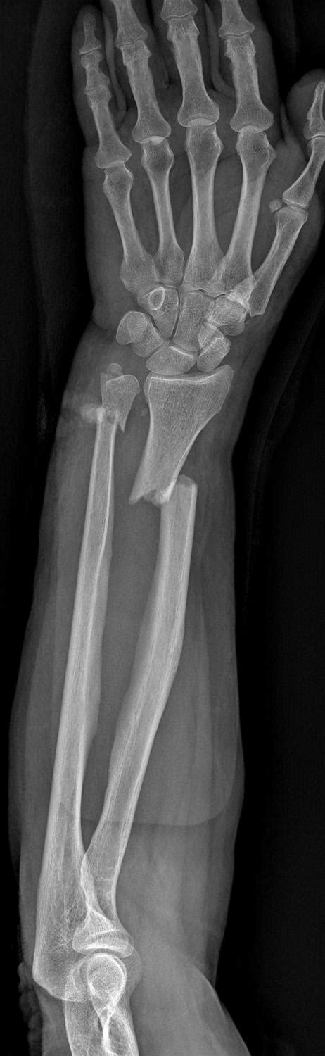 Radius Fracture 的图像结果