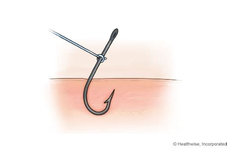 Image result for String Pull Method Fish Hook Removal