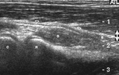 Posterior Interosseous Nerve Palsy