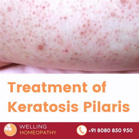 Homeopathy Treatment Of Keratosis Pilaris