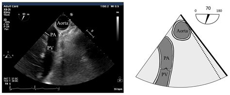 Perioperative Considerations, Anesthetic Management and Transesophageal ...