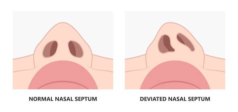 Deviated Nasal Septum - Diagnosis & Treatment | Aglow ENT Centre