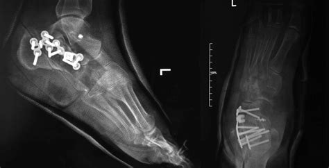 Stark und anatomisch: ein neues Implantatsystem für alle Fälle ...