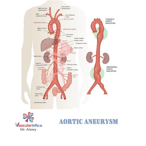 Thoracic Aorta