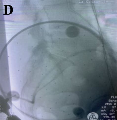 Image result for Fluoroscopy Injection