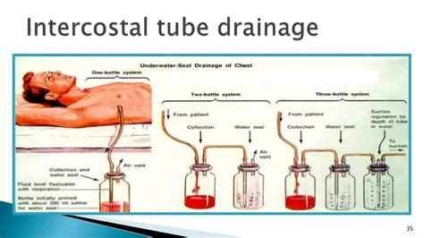 Decortication of the lung.pptx