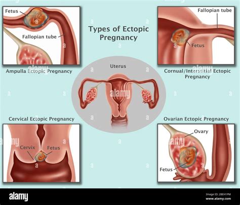 How Common Is Ectopic Pregnancy