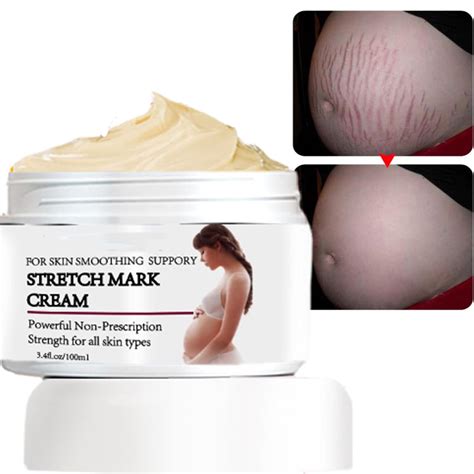 Products For Stretch Marks When Pregnant at Sean Hawker blog