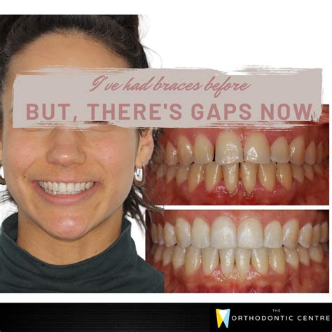Braces Before And After Gap