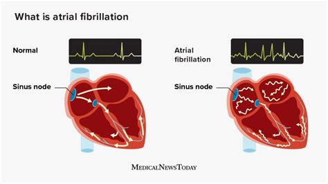 Image result for Delta Modulation Kit Connection