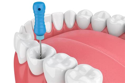 Image result for Tooth Root Extraction