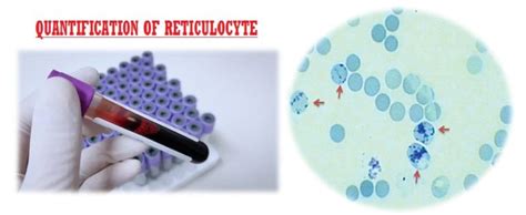 Image result for Retics Count by Flow Cytometry