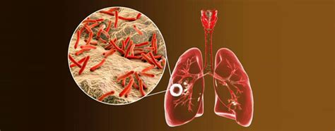 Best Tuberculosis Specialist in Vashi | Dr Jayalakshmi TK