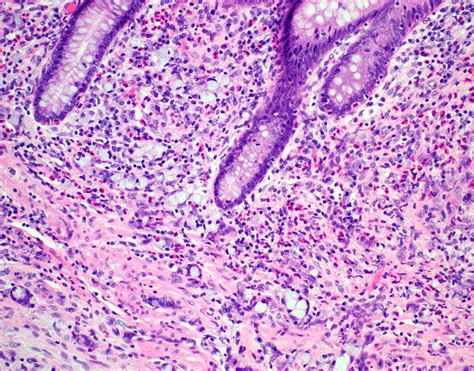 Goblet Cell Adenocarcinoma of the Appendix: Diagnosis, Prognosis and Nomenclature