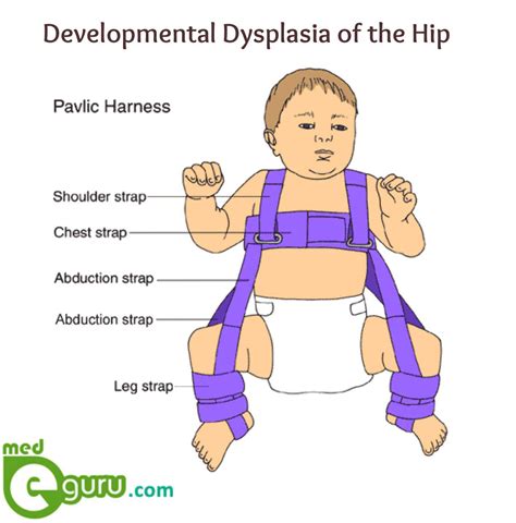 Congenital Hip Dysplasia