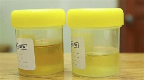 BOJA URINA OTKRIVA JESTE LI TEŠKO BOLESNI: Obratite Pažnju, OVE ZNAKOVE ...