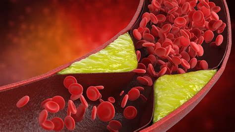 High Cholesterol Can be Inherited: All You Need To Know About Familial ...