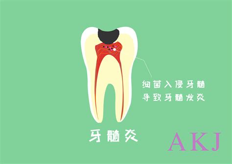 牙髓炎的症状和原因是什么？ - 知乎