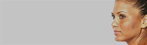 Melasma Treatment Cost in Bangalore | Melasma Treatment In Bangalore