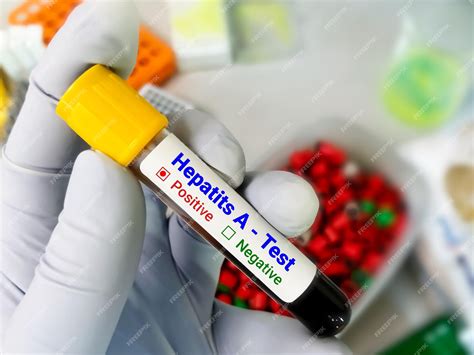 Premium Photo | Blood sample for hepatitis a virus hav test highly contagious liver infection