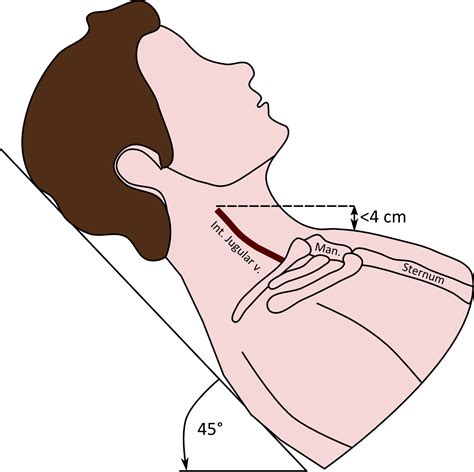 Flat Jugular Veins Photos - Jvp Angle Of Louis (1330x1326), Png Download