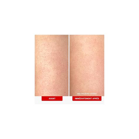 First Aid Beauty KP Bump Eraser Body Scrub with 10% India | Ubuy