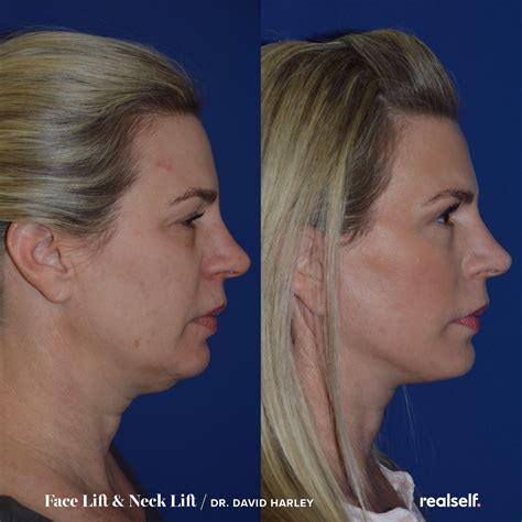 16 Things I Wish I Knew Before Getting a Facelift - Facelift forum | Neck lift, Neck lift ...