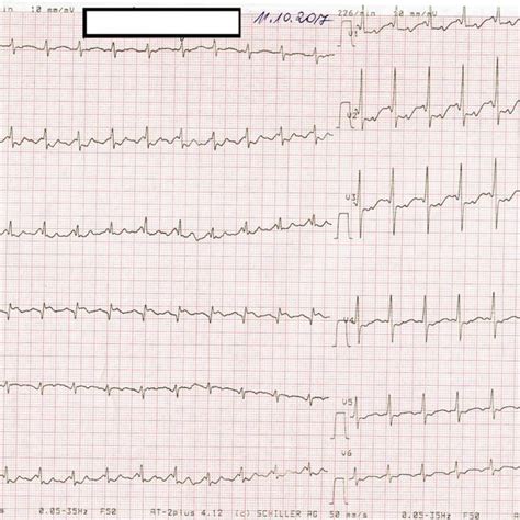 Image result for Atrial Flutter Synchronized Cardioversion