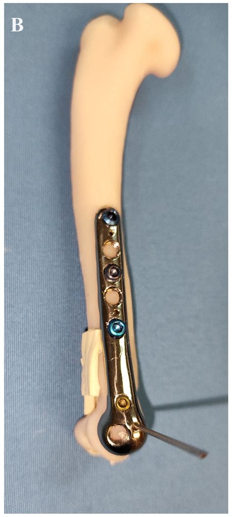 A 3D Printed Anatomically Pre-Contoured Plate for the Treatment of Y-T ...