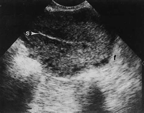 Fertility Ultrasound Endometrium