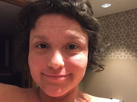 Eczema On Face During Pregnancy at Elba Wake blog