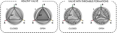 Innovative IntraValvular Impedance Sensing Applied to Biological Heart ...