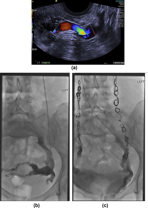 Symptomatic pelvic venous insufficiency: a review of the current ...