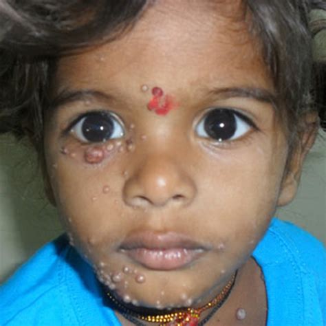 Quality of Life in Pediatric Atopic Dermatitis: A Northern India ...