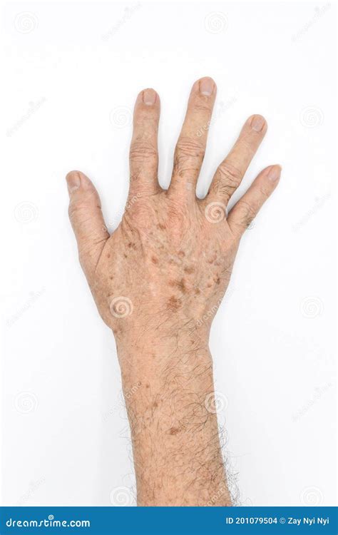 Age Spots on Hand of Asian Elder Man. they are Brown, Gray, or Black Spots and Also Called Liver ...
