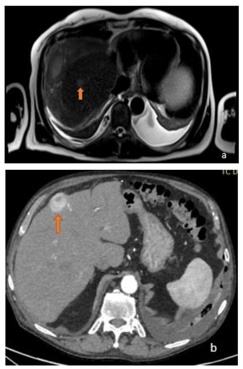 Focal Lesions of the Liver and Radiomics: What Do We Know?