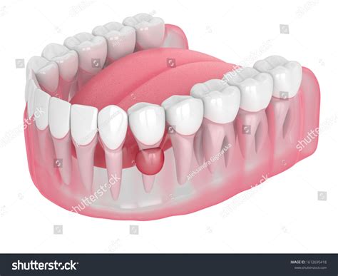 White Cyst On Gum Line