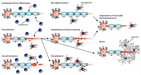 Pathogenesis of multiple sclerosis: insights from molecular and metabolic imaging - The Lancet ...