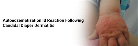 Autoeczematization Id reaction following candidal diaper dermatitis