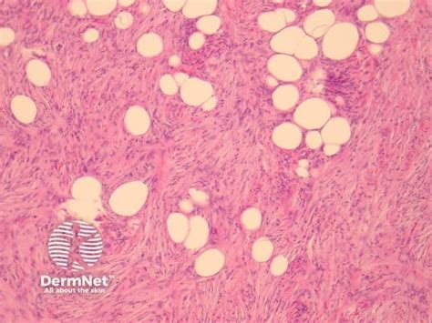 Image result for Dermatofibrosarcoma Protuberans