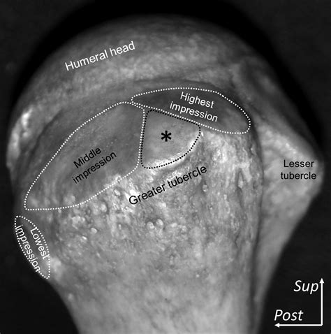 The anatomic relationship between the morphology of the greater tubercle of the humerus and the ...