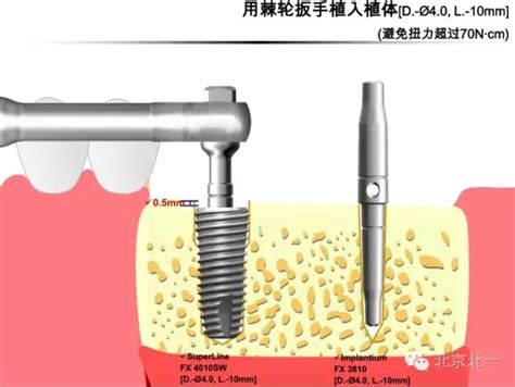 【口腔种植】韩国Dentium种植体植入外科流程|牙科种植|陕西嘉友科贸有限公司