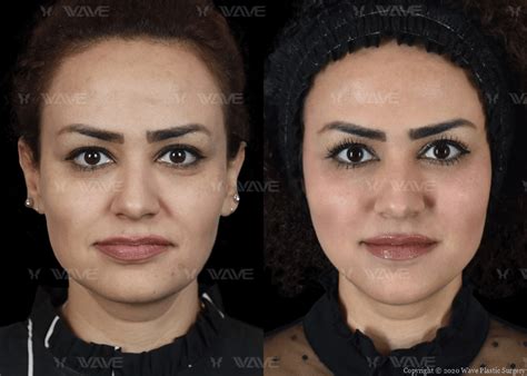 New Thread Lift 的图像结果