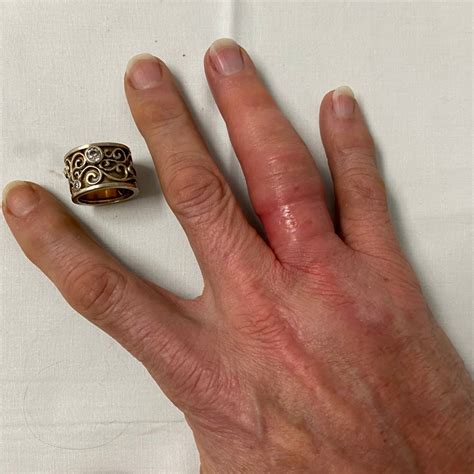 Image result for Ring Removal String Technique
