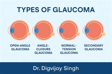 What Is Glaucoma? Symptoms, Causes, Treatment & Prevention