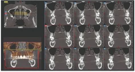 Dental X Ray Machine - NewTom CBCT Go3D Wholesale Trader from New Delhi