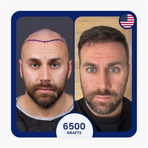 Hair Transplant in Korea vs Turkey - Vera Clinic