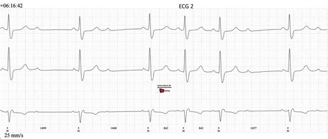 Second-degree AV Block, Mobitz Type II | ECG Guru - Instructor Resources